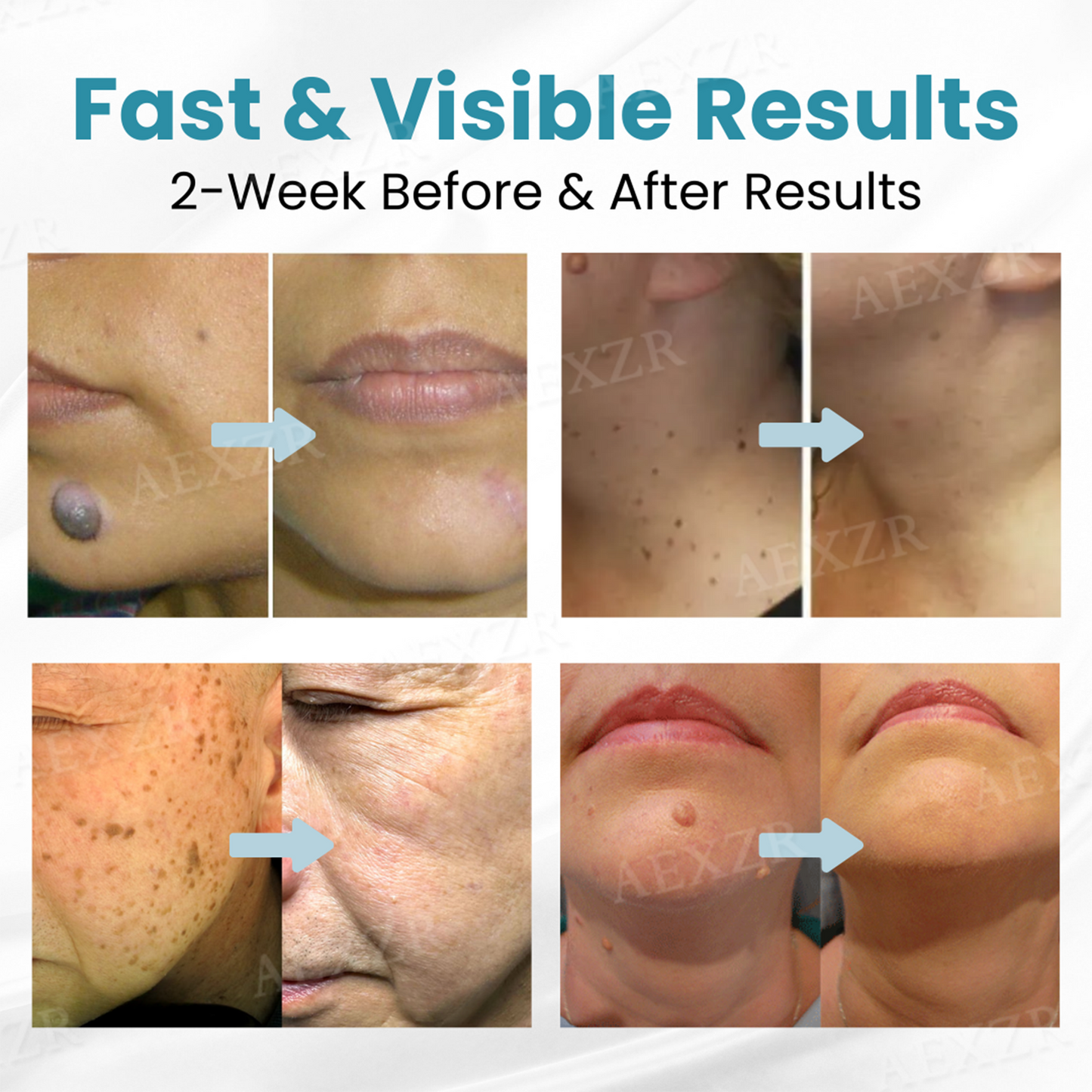 Bikenda® PRO Non-Invasive Mole and Wart Removal Laser Pen